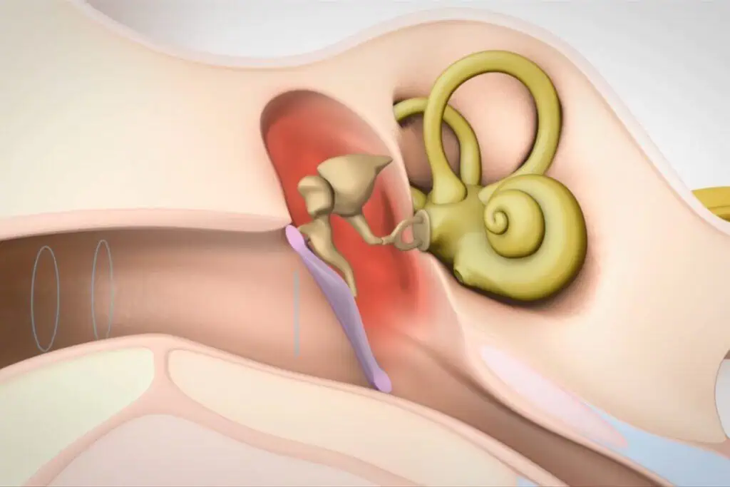 Mild and Moderate Hearing Loss